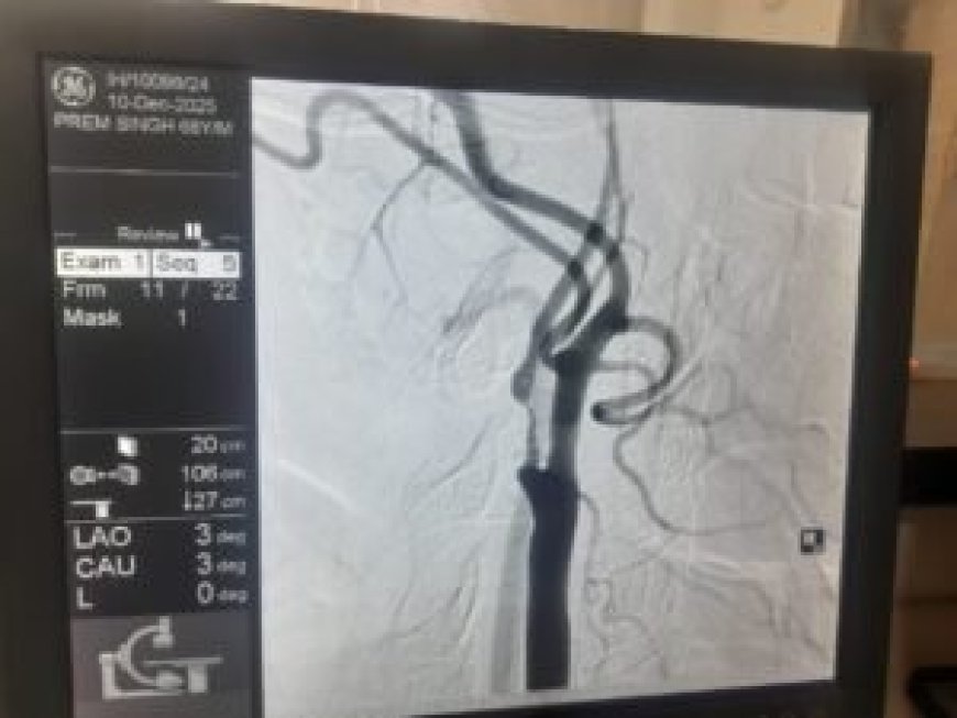 VELMED Hospital, Dehradun में स्ट्रोक से बचाव के लिए जटिल सर्जरी सफल